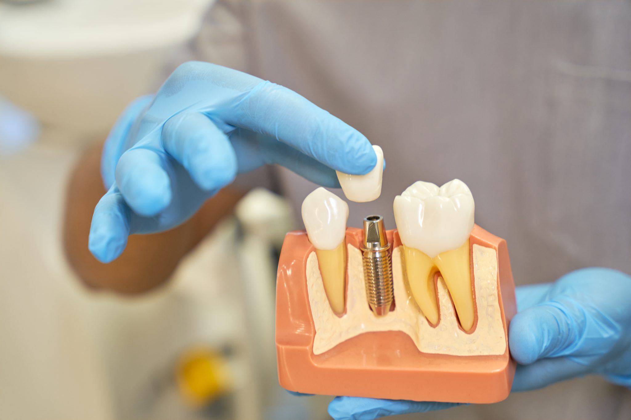 What is Implant Dentistry? - Dental Health News
